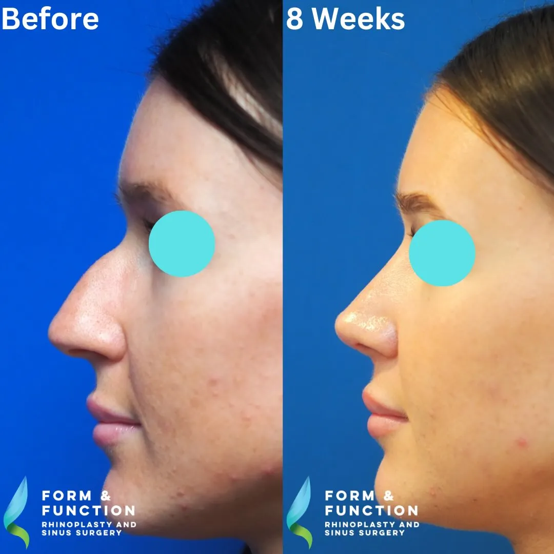 Before and after, 8 weeks after rhinoplasty and septoplasty (photograph 5 of 6)