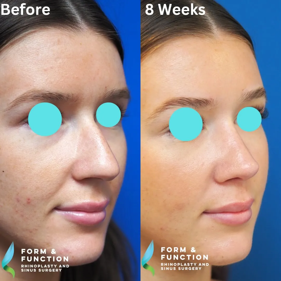 Before and after, 8 weeks after rhinoplasty and septoplasty (photograph 6 of 6)