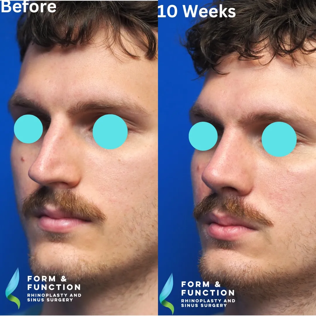Before and after, left three-quarter view, 10 weeks after rhinoplasty with septal reconstruction