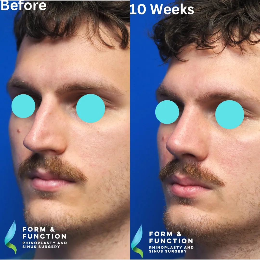 Before and after, left three-quarter view, 10 weeks after rhinoplasty with septal reconstruction