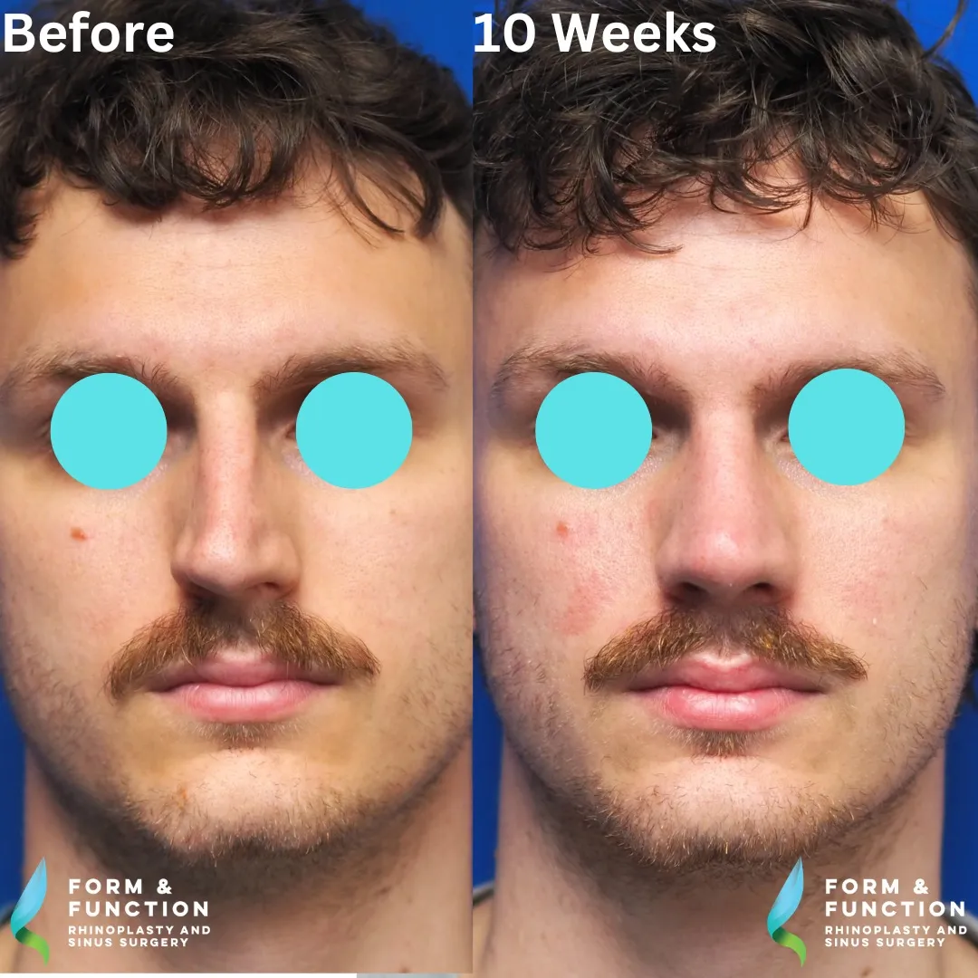 Before and after, frontal view, 10 weeks after rhinoplasty with septal reconstruction