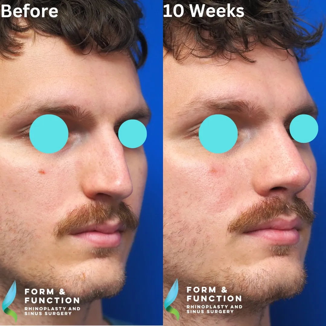 Before and after, right three-quarter view, 10 weeks after rhinoplasty with septal reconstruction