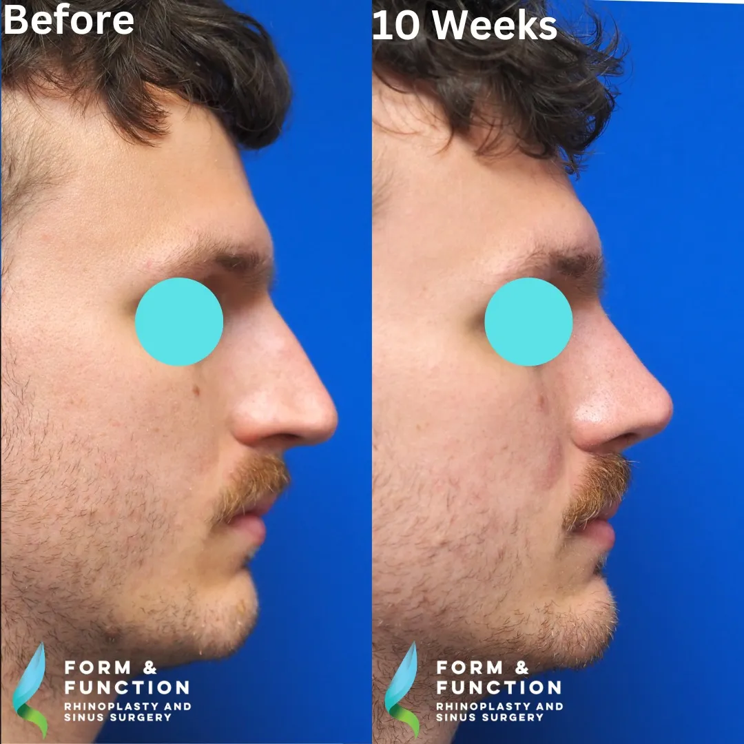 Before and after, right profile, 10 weeks after rhinoplasty with septal reconstruction