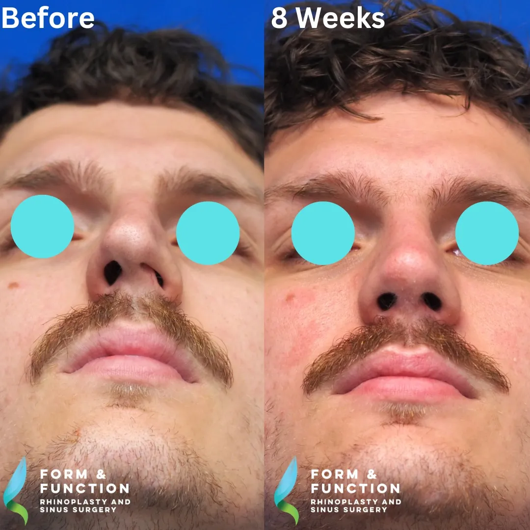 Before and after, base view, 10 weeks after rhinoplasty with septal reconstruction