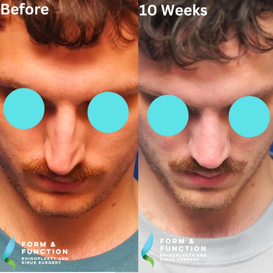 Before and after, 10 weeks after rhinoplasty with septal reconstruction (photograph 6 of 6)