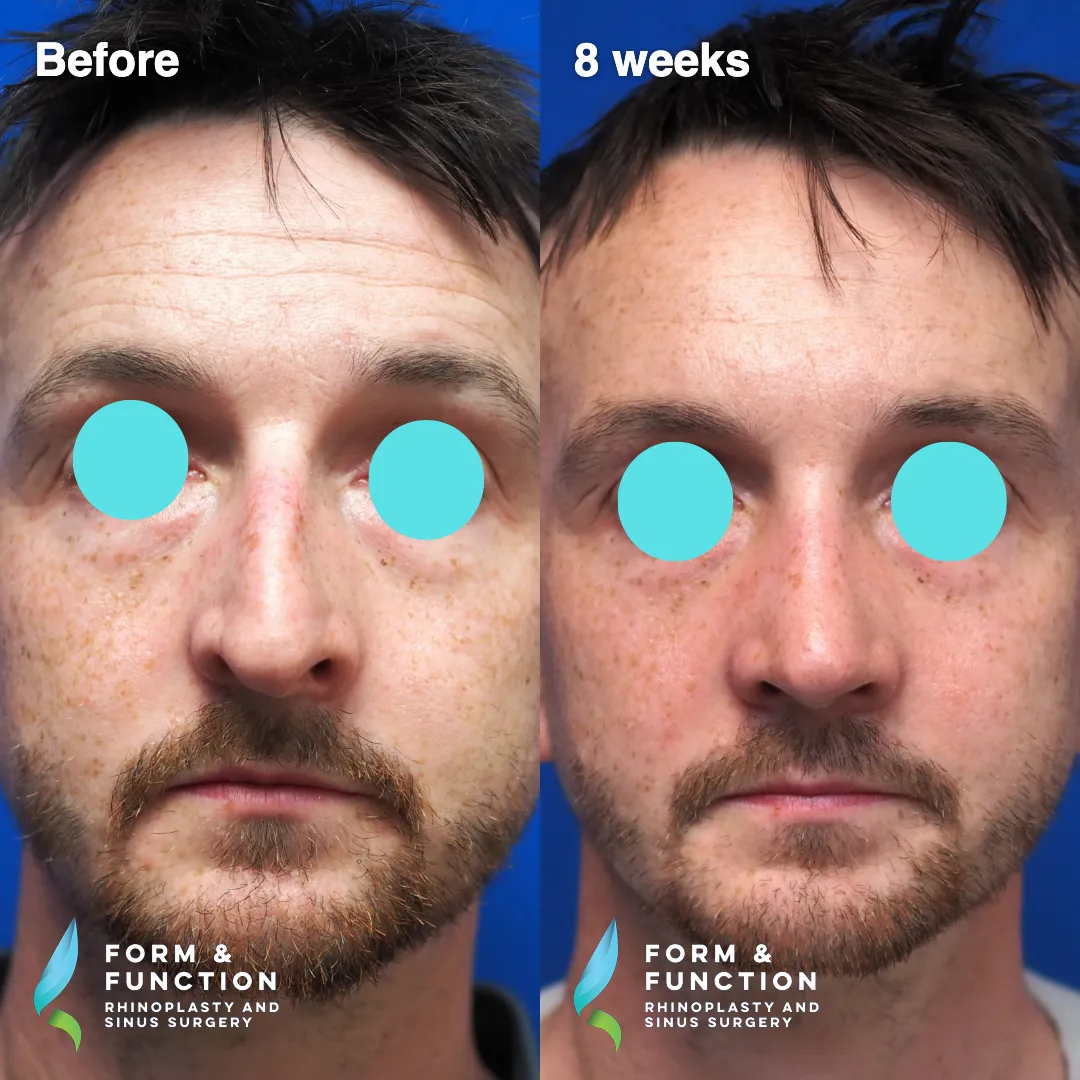 Before and after, right profile, 8 weeks after rhinoplasty with septal reconstruction