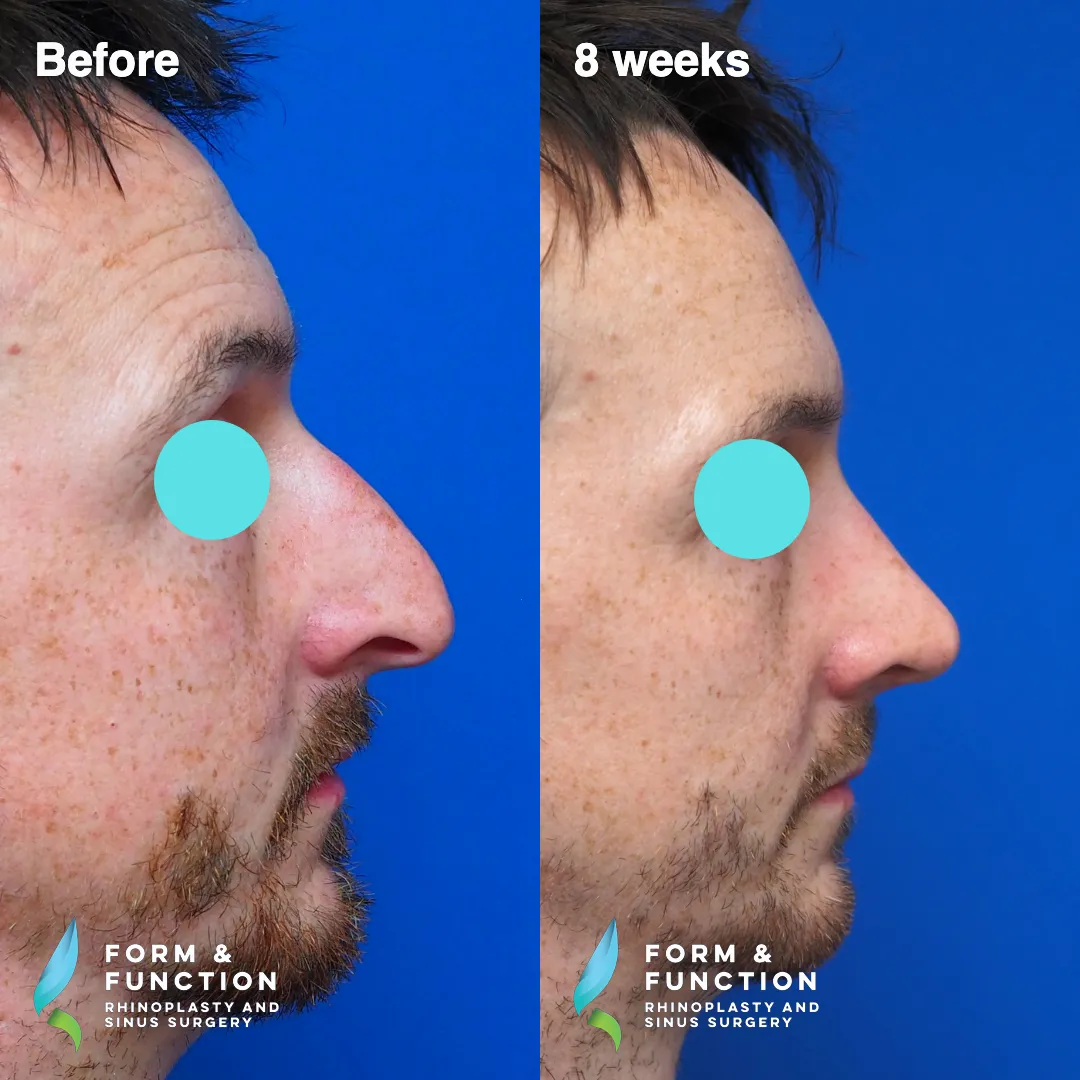 Before and after, left three-quarter view, 8 weeks after rhinoplasty with septal reconstruction