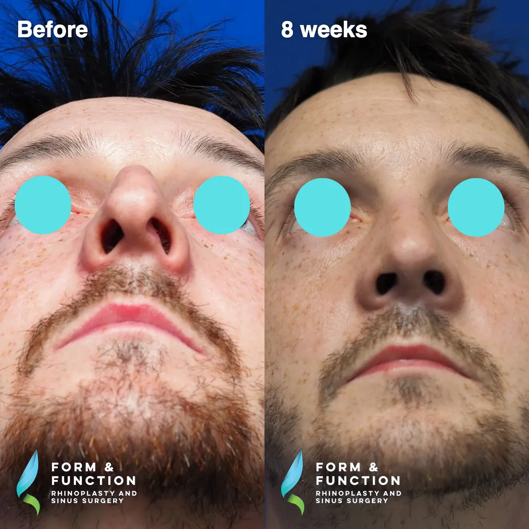 Before and after, frontal view, 8 weeks after rhinoplasty with septal reconstruction