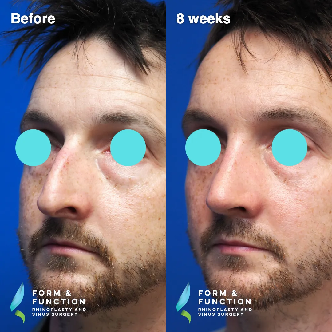 Before and after, right three-quarter view, 8 weeks after rhinoplasty with septal reconstruction