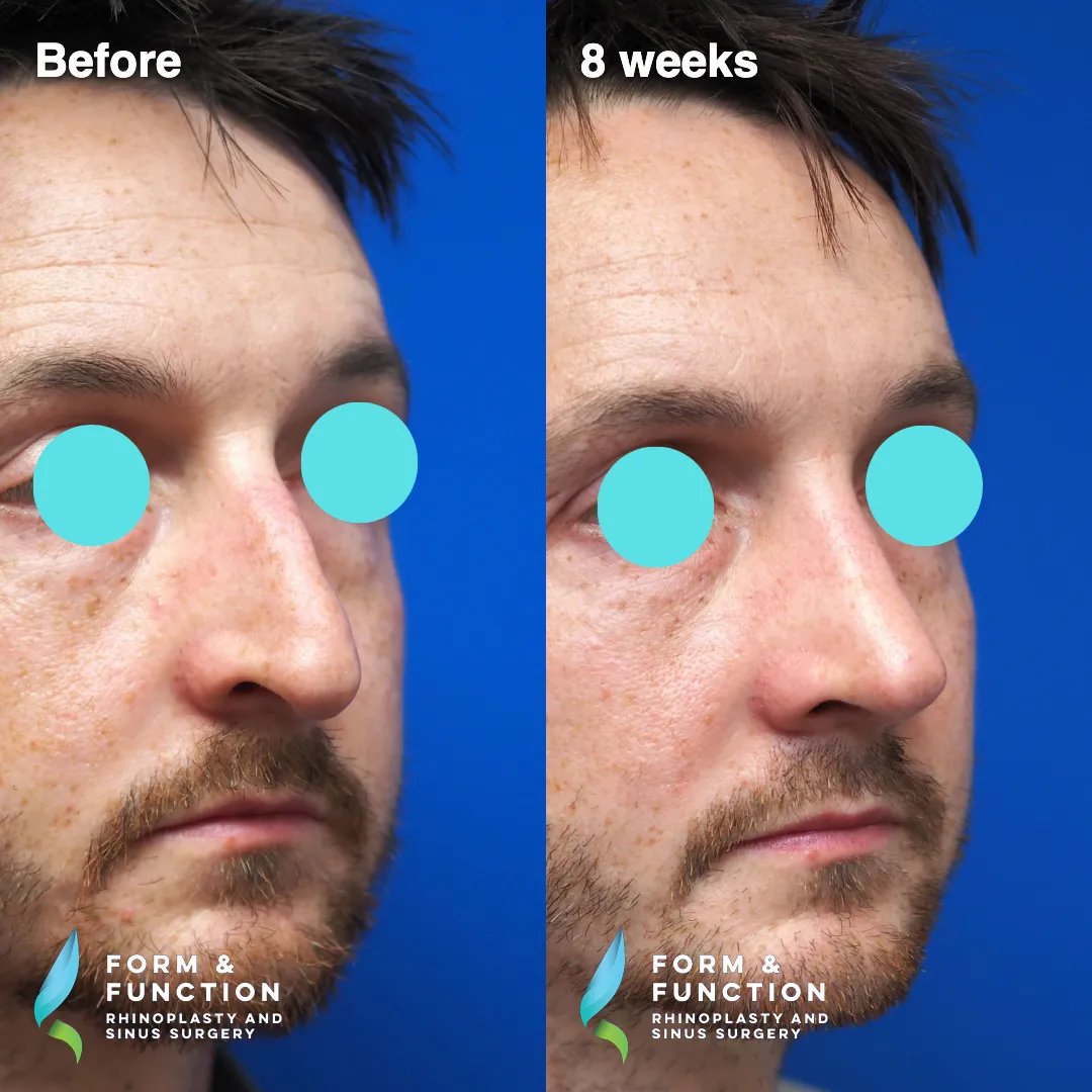 Before and after, 8 weeks after rhinoplasty with septal reconstruction (photograph 5 of 7)
