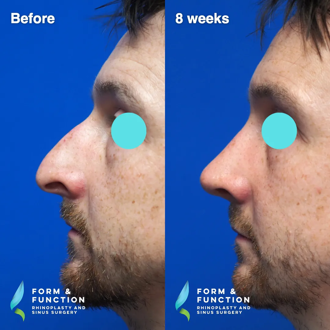 Before and after, base view, 8 weeks after rhinoplasty with septal reconstruction
