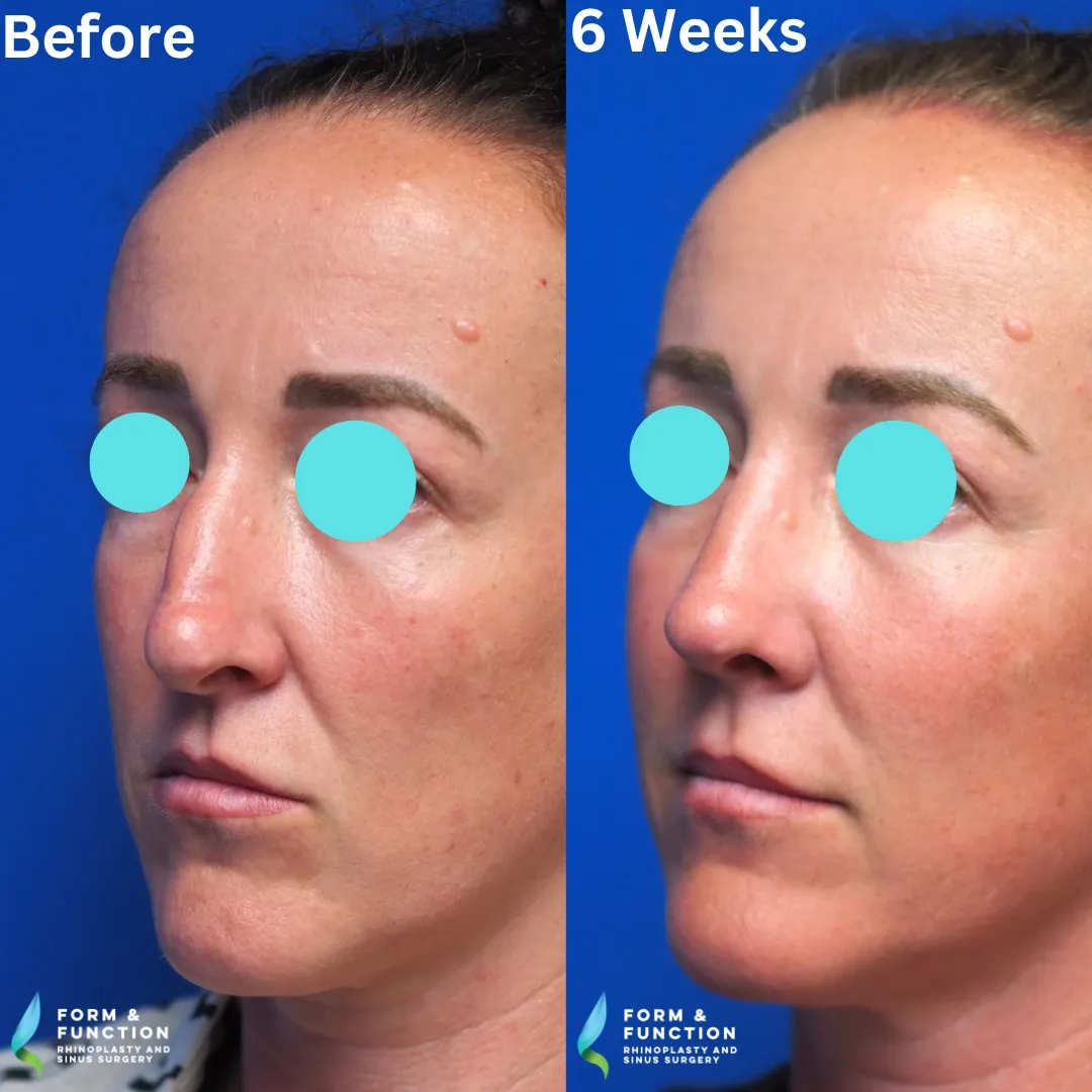 Before and after, left three-quarter view, 6 weeks after rhinoplasty and septoplasty