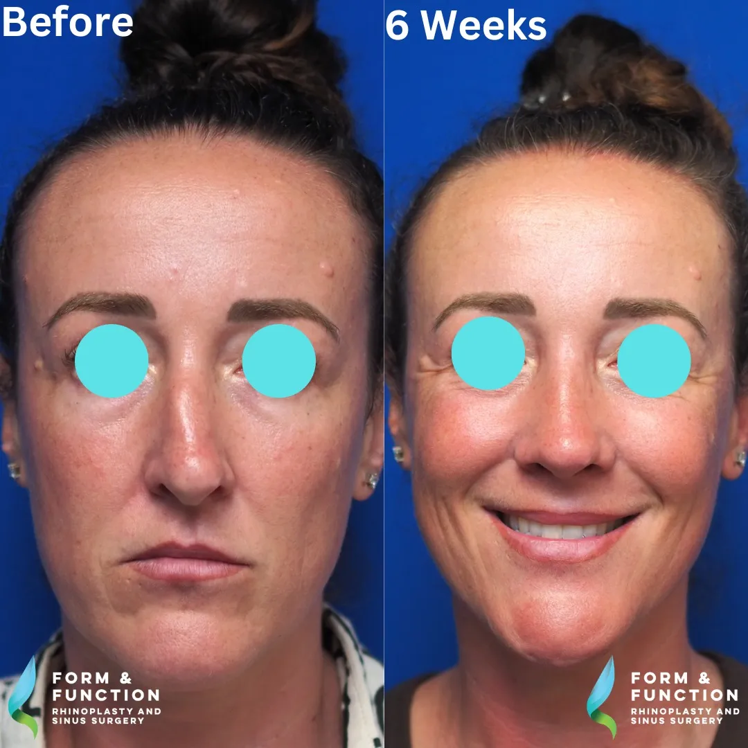 Before and after, frontal view, 6 weeks after rhinoplasty and septoplasty