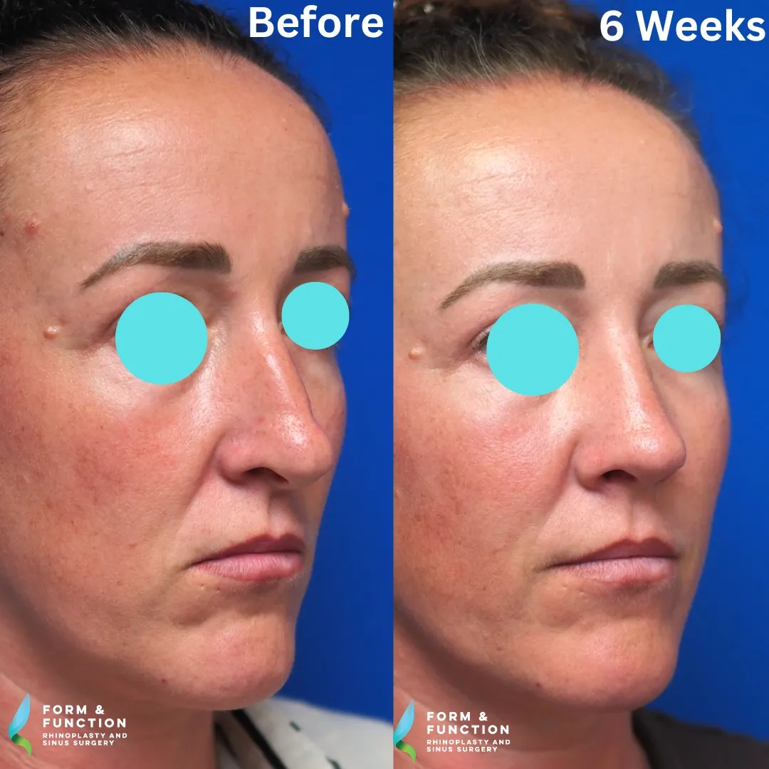 Before and after, 6 weeks after rhinoplasty and septoplasty (photograph 3 of 5)