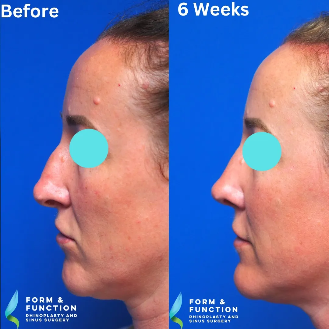 Before and after, right profile, 6 weeks after rhinoplasty and septoplasty