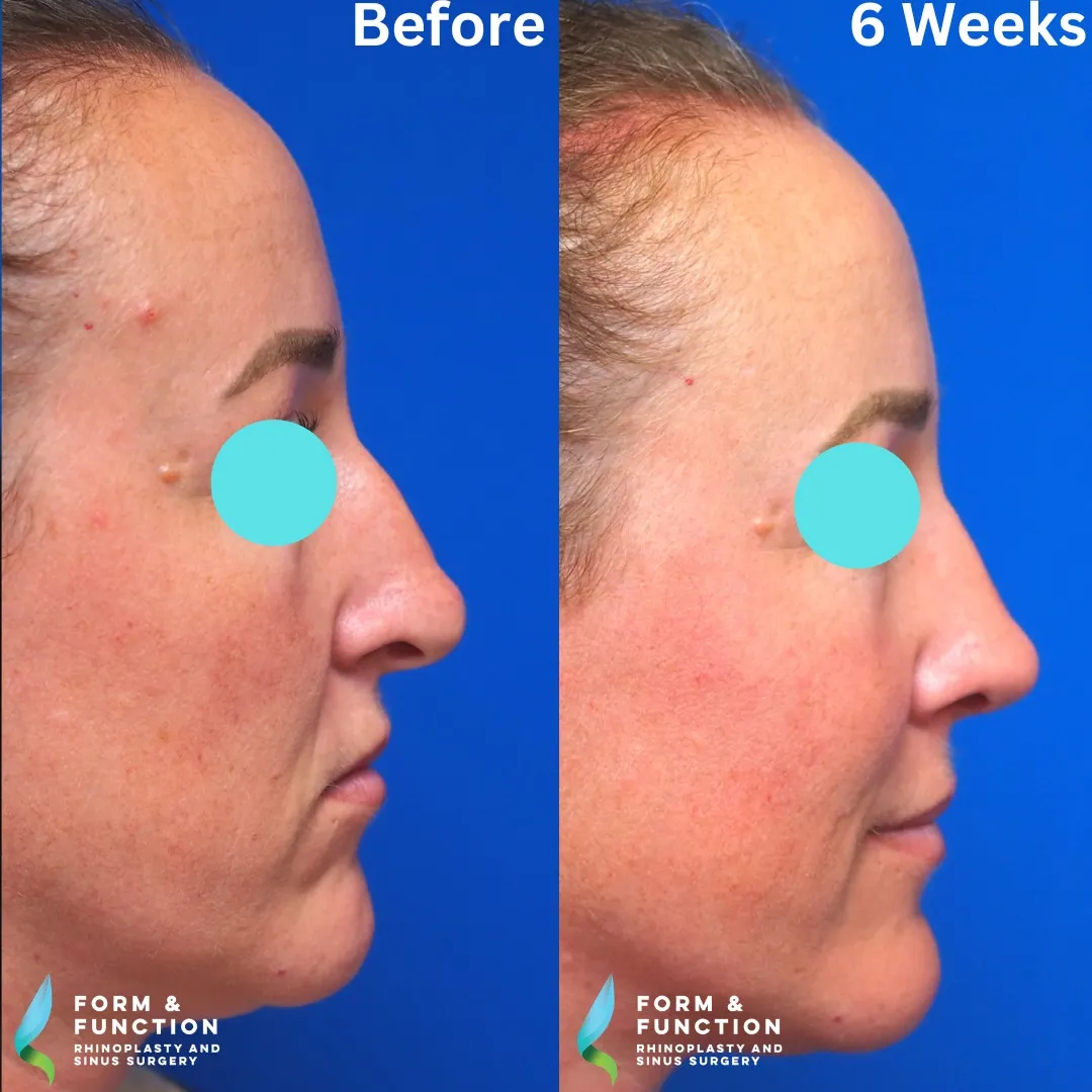 Before and after, 6 weeks after rhinoplasty and septoplasty (photograph 5 of 5)