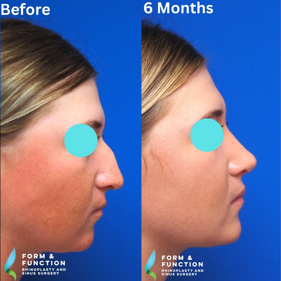 Before and after, right profile, 6 months after rhinoplasty and septoplasty