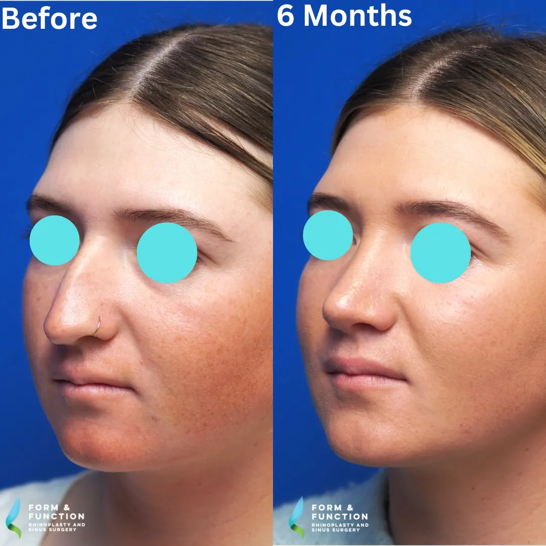 Before and after, right three-quarter view, 6 months after rhinoplasty and septoplasty