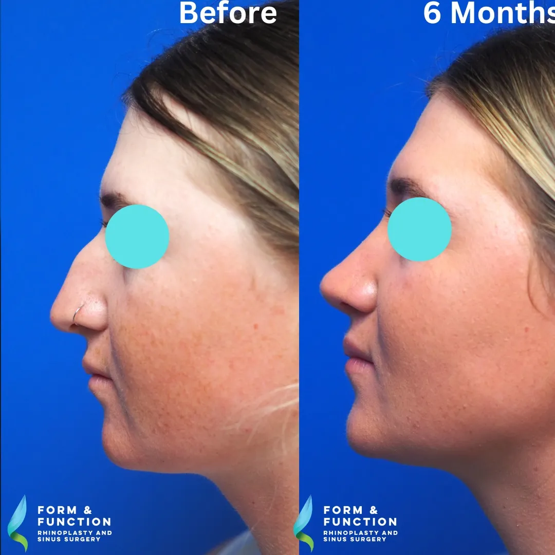 Before and after, left profile, 6 months after rhinoplasty and septoplasty