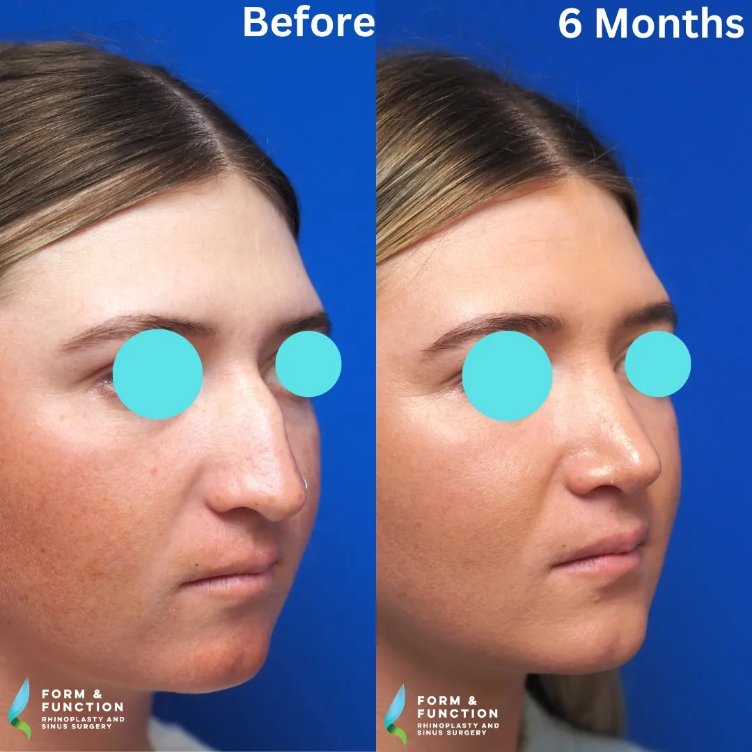 Before and after, 6 months after rhinoplasty and septoplasty (photograph 4 of 4)