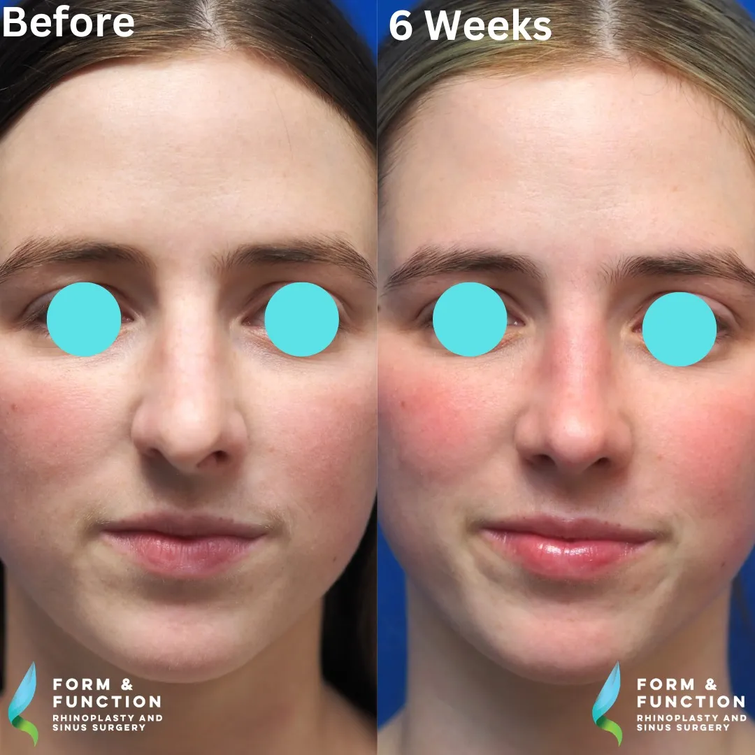 Before and after, frontal view, 6 weeks after rhinoplasty with septal reconstruction