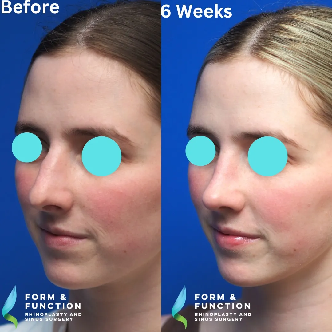 Before and after, left three-quarter view, 6 weeks after rhinoplasty with septal reconstruction