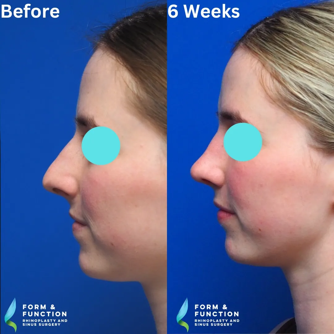 Before and after, right profile, 6 weeks after rhinoplasty with septal reconstruction