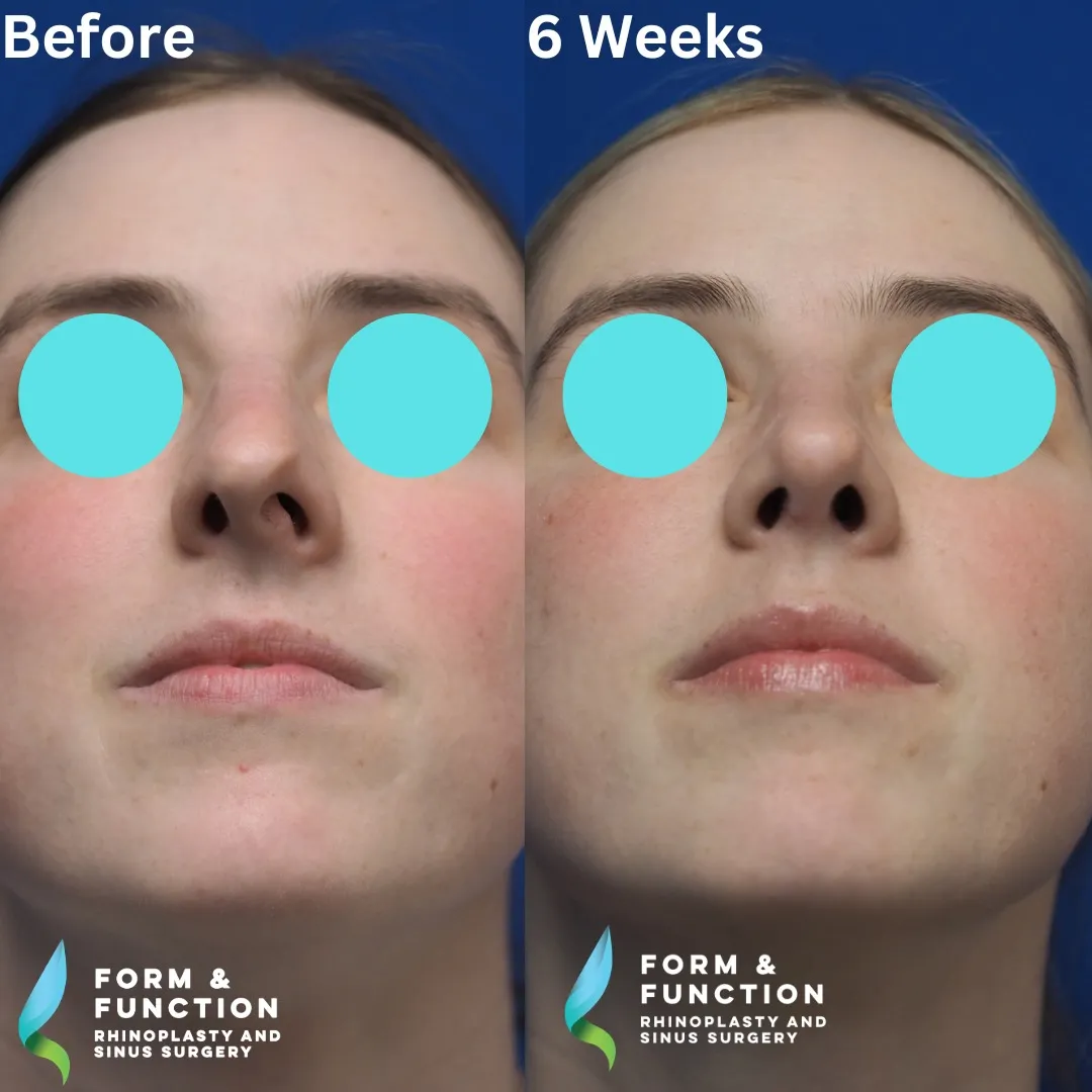 Before and after, base view, 6 weeks after rhinoplasty with septal reconstruction