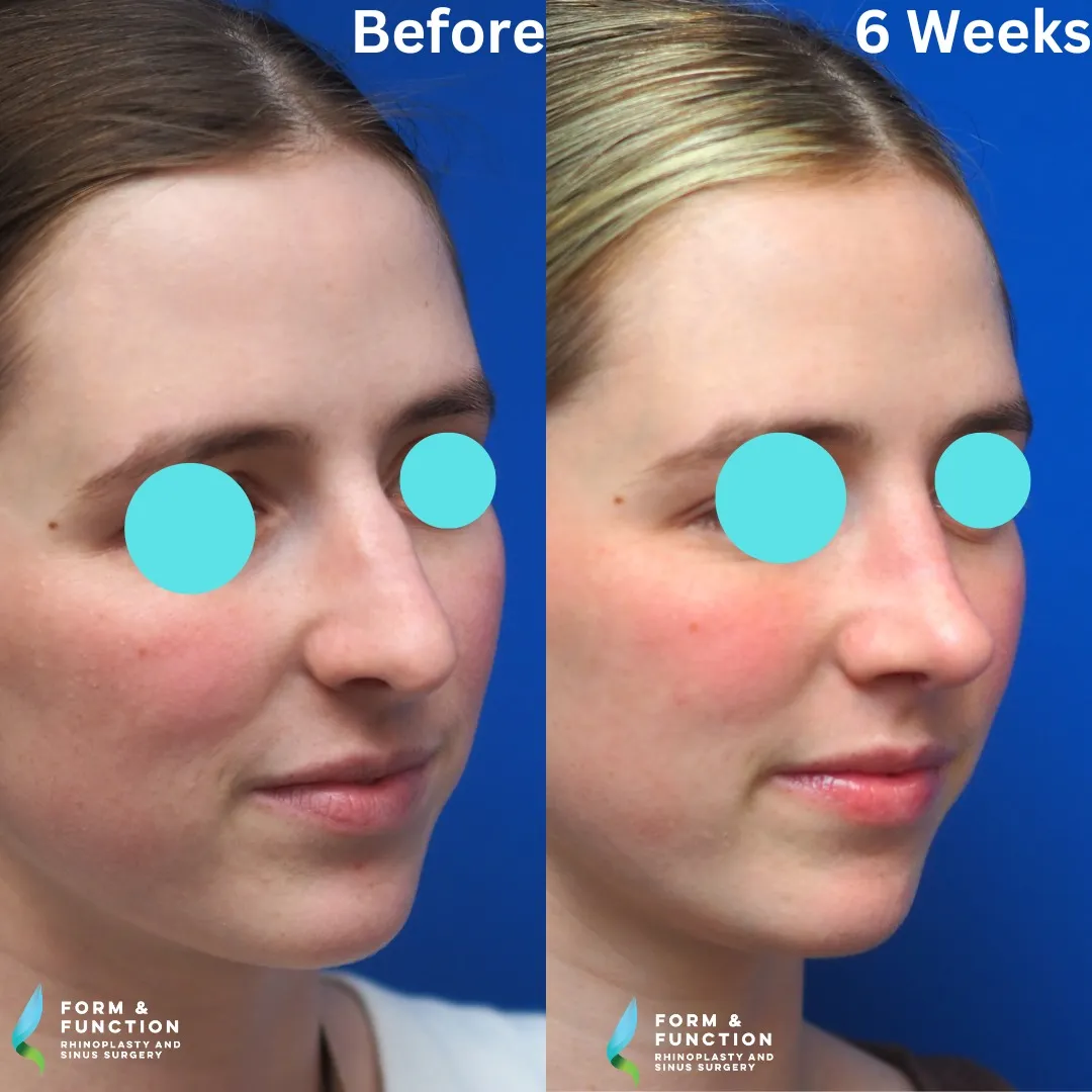 Before and after, right three-quarter view, 6 weeks after rhinoplasty with septal reconstruction