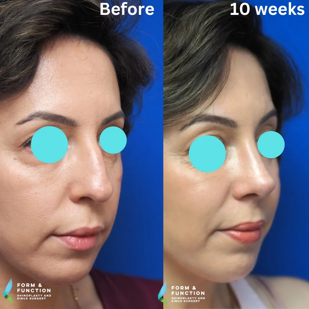 Before and after, right three-quarter view, 10 weeks after rhinoplasty and septoplasty