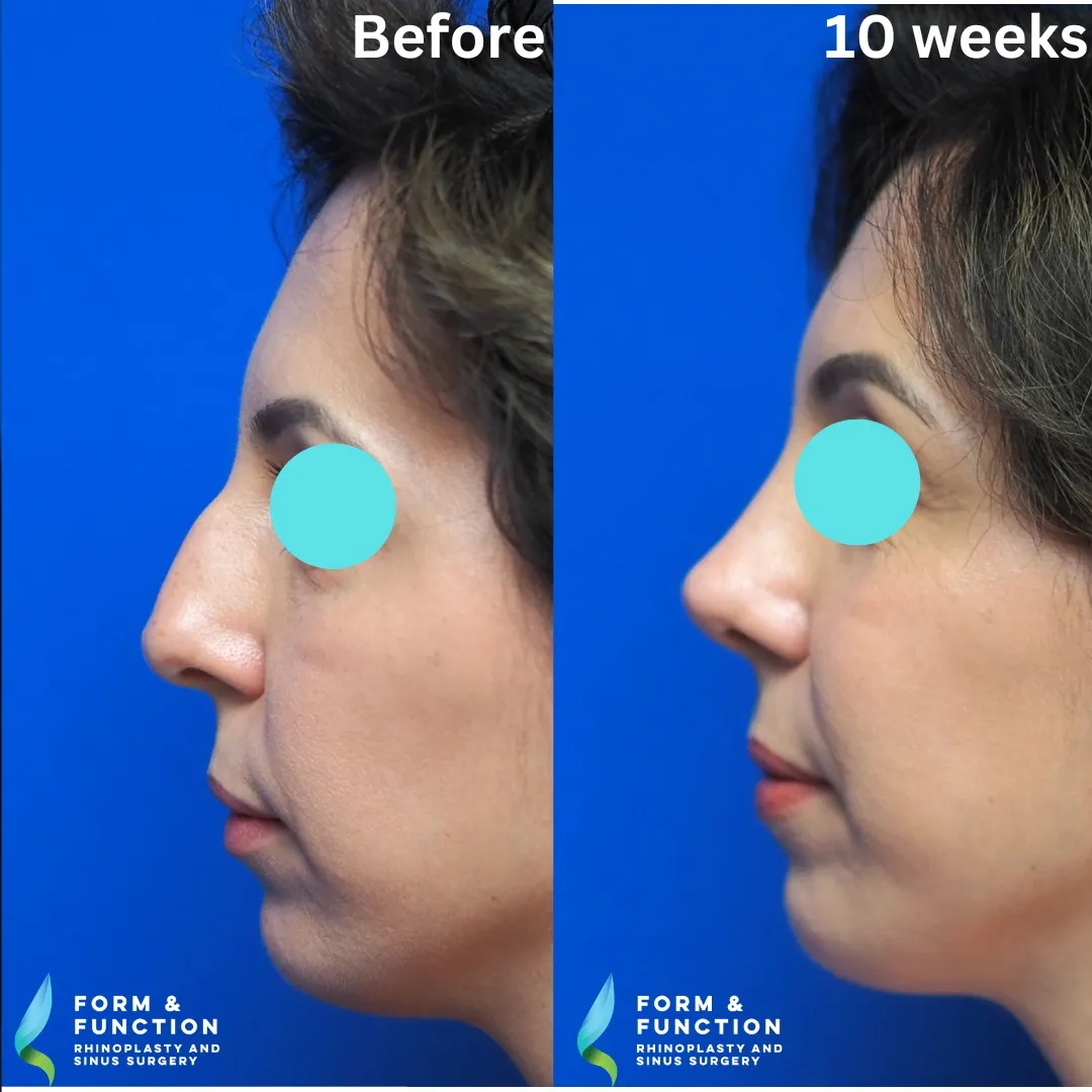 Before and after, left profile, 10 weeks after rhinoplasty and septoplasty