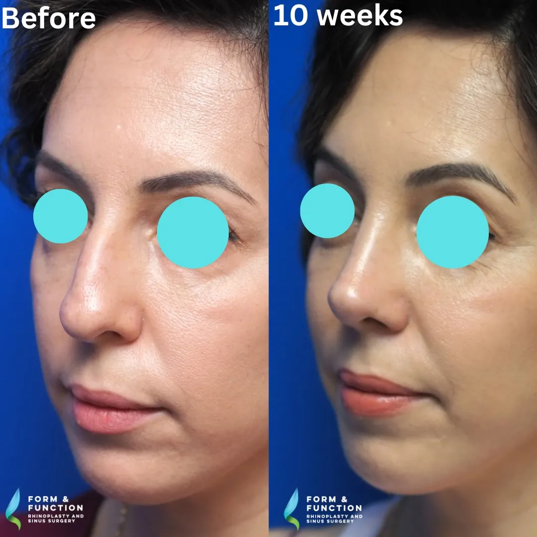 Before and after, 10 weeks after rhinoplasty and septoplasty (photograph 3 of 6)