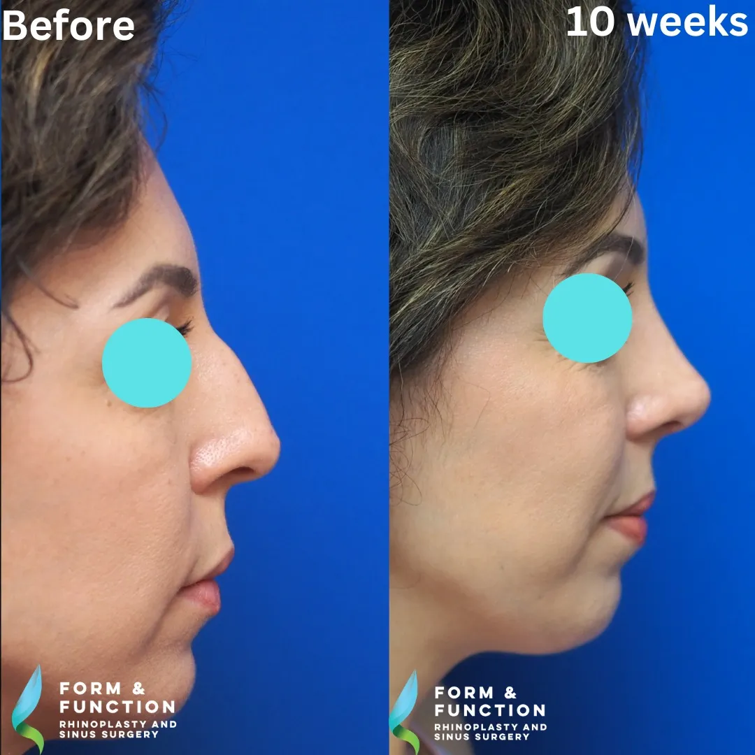 Before and after, right profile, 10 weeks after rhinoplasty and septoplasty