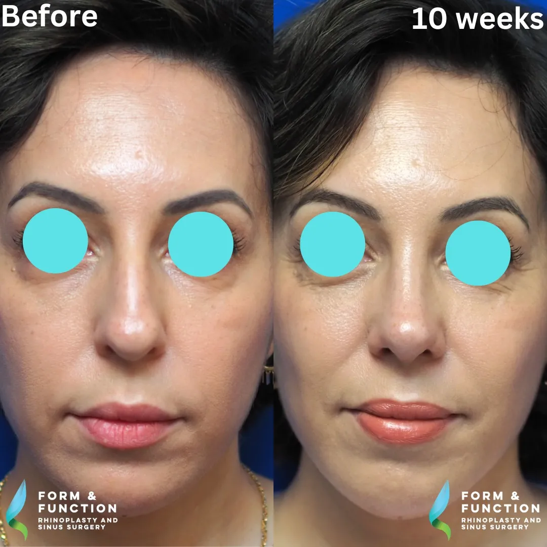 Before and after, frontal view, 10 weeks after rhinoplasty and septoplasty