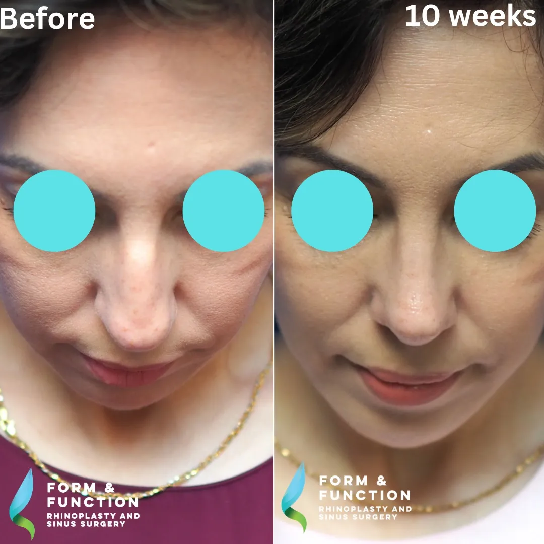 Before and after, 10 weeks after rhinoplasty and septoplasty (photograph 6 of 6)