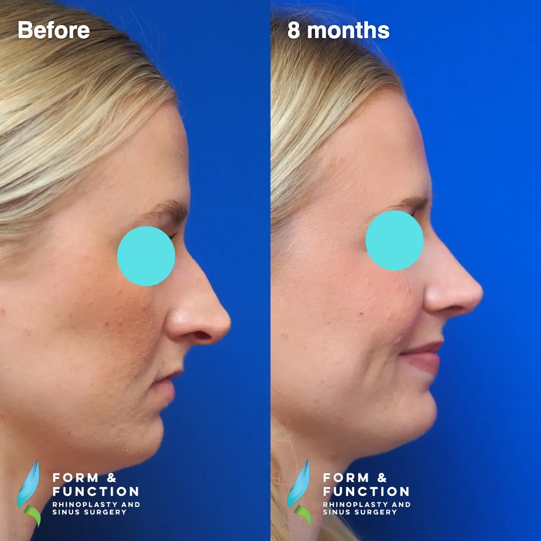 Before and after, frontal view, 8 months after rhinoplasty and septoplasty