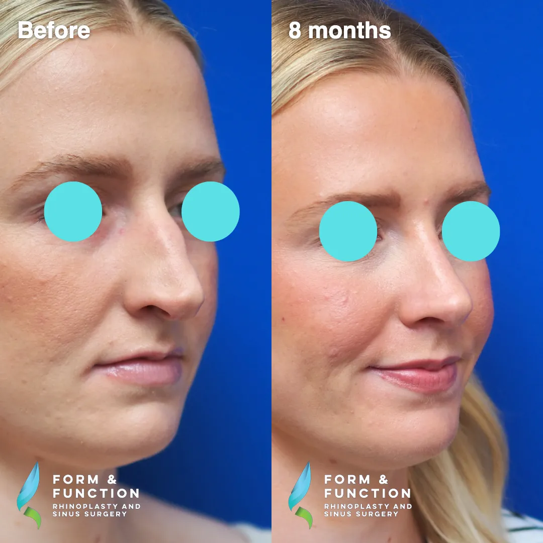 Before and after, right three-quarter view, 8 months after rhinoplasty and septoplasty