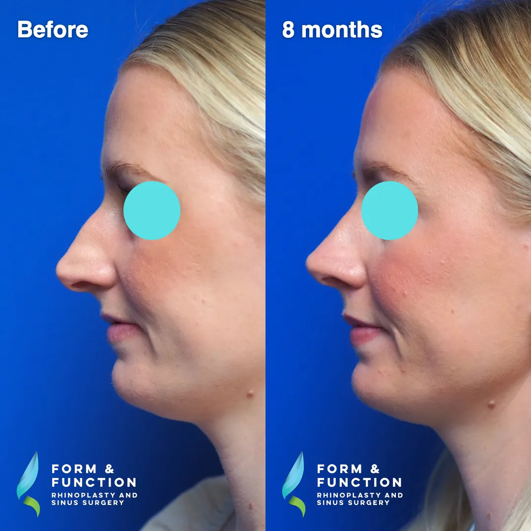 Before and after, left three-quarter view, 8 months after rhinoplasty and septoplasty