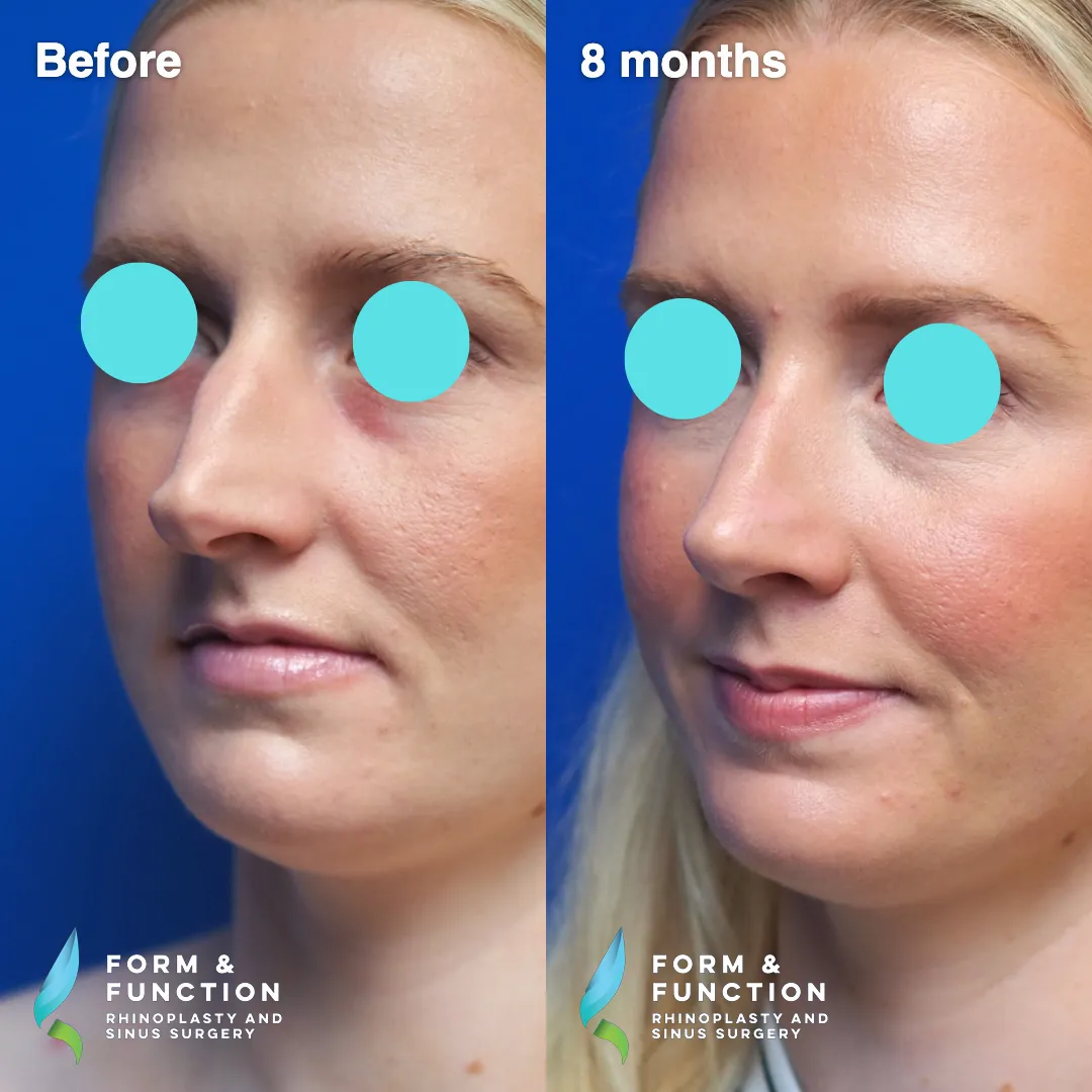 Before and after, right profile, 8 months after rhinoplasty and septoplasty