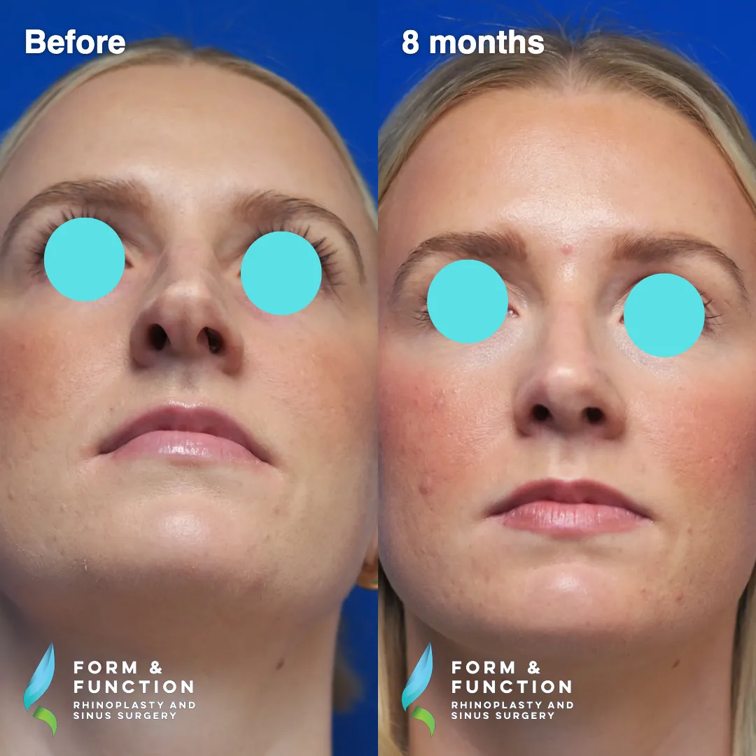 Before and after, base view, 8 months after rhinoplasty and septoplasty