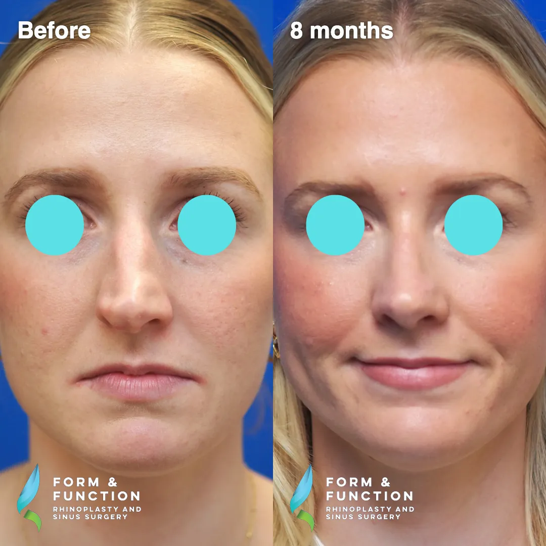 Before and after, 8 months after rhinoplasty and septoplasty (photograph 6 of 6)