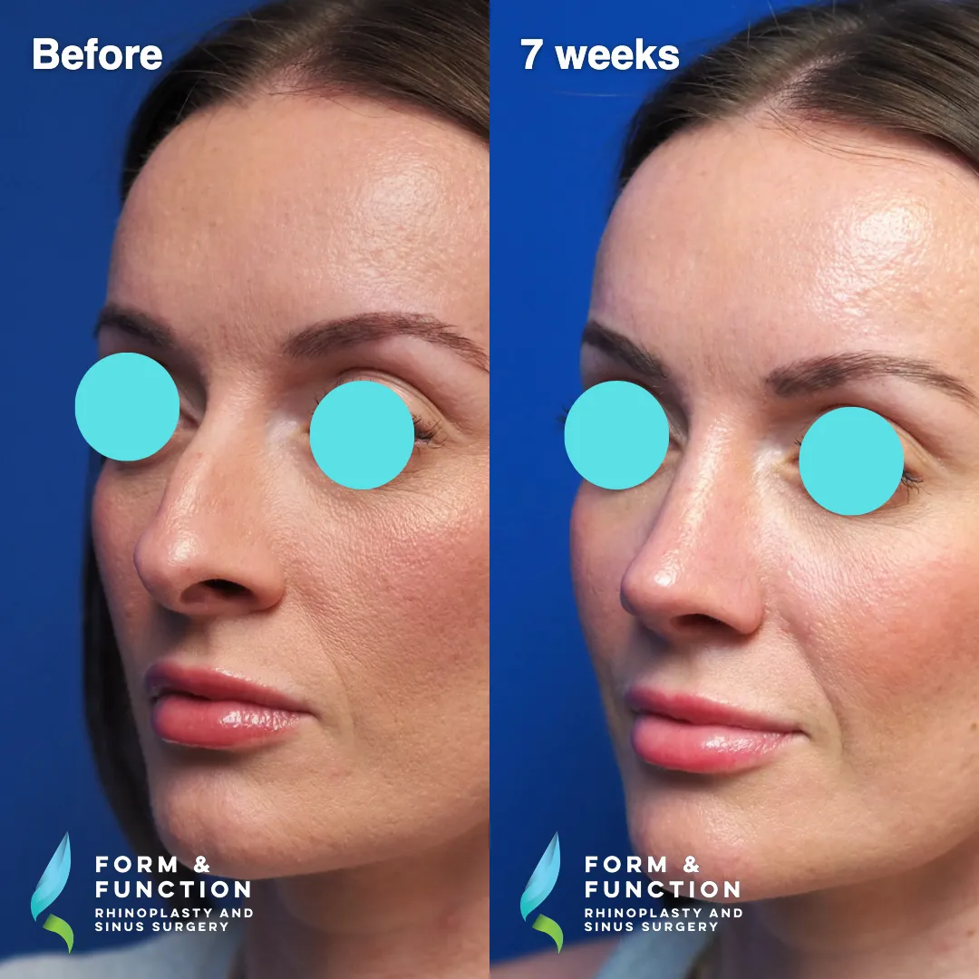 Before and after, left profile, 7 weeks after rhinoplasty