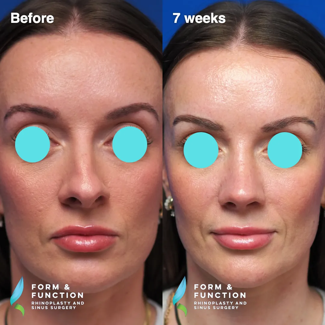 Before and after, left three-quarter view, 7 weeks after rhinoplasty
