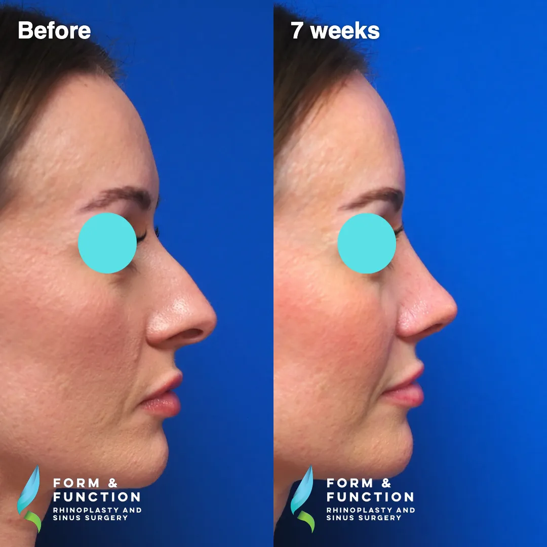 Before and after, right three-quarter view, 7 weeks after rhinoplasty