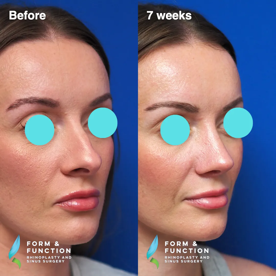 Before and after, right profile, 7 weeks after rhinoplasty