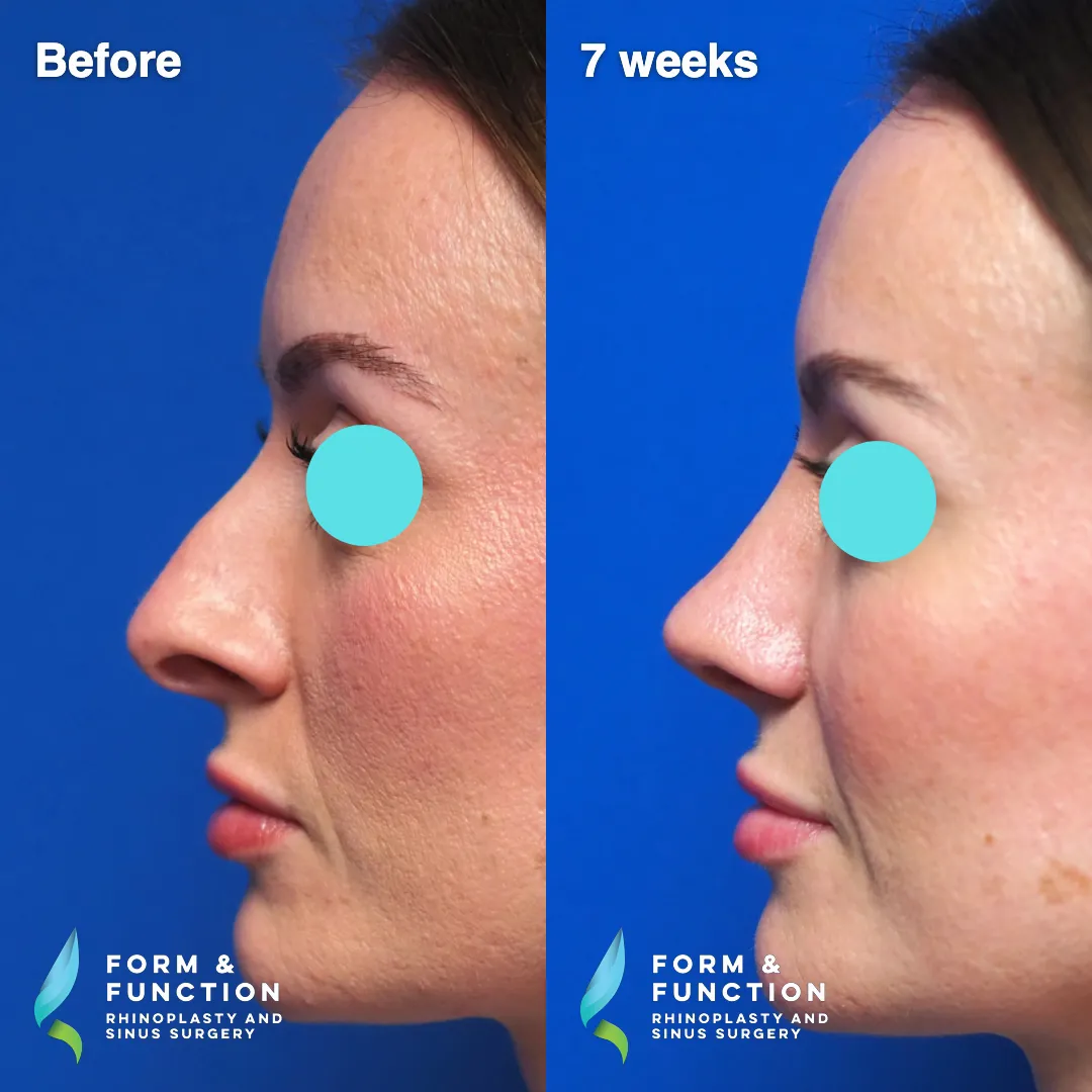 Before and after, frontal view, 7 weeks after rhinoplasty