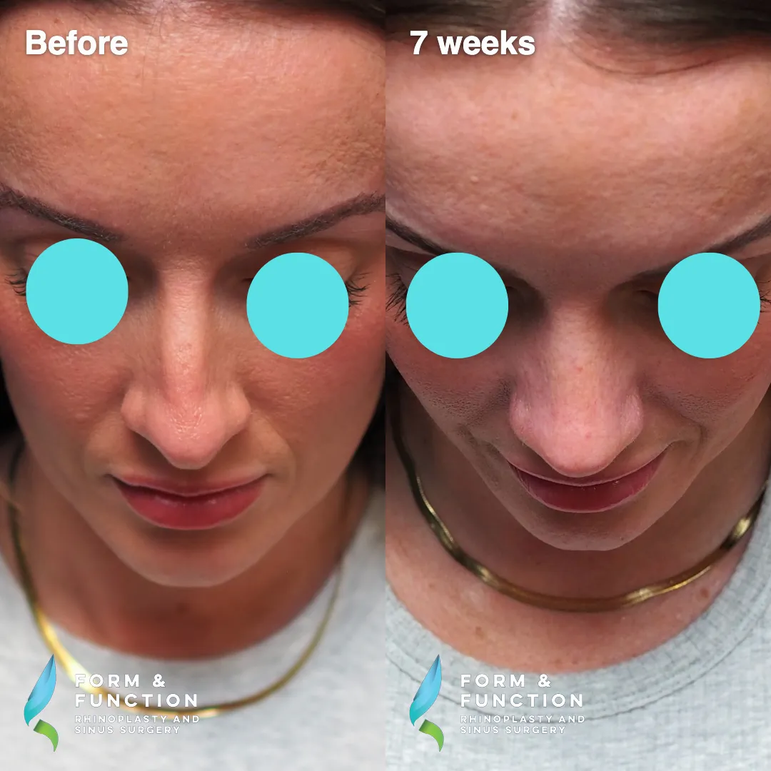 Before and after, base view, 7 weeks after rhinoplasty