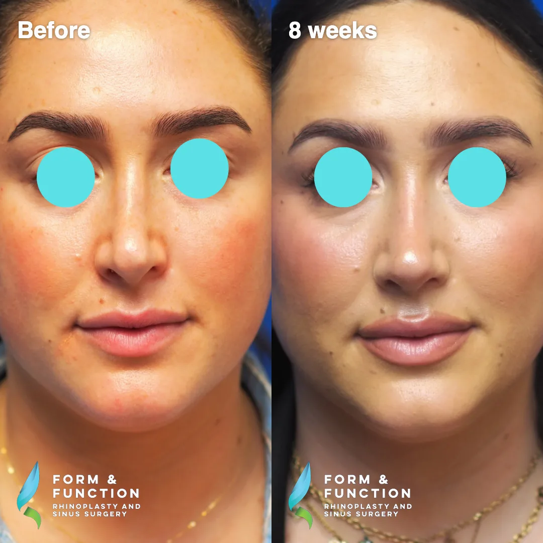 Before and after, frontal view, 8 weeks after revision rhinoplasty with septal reconstruction