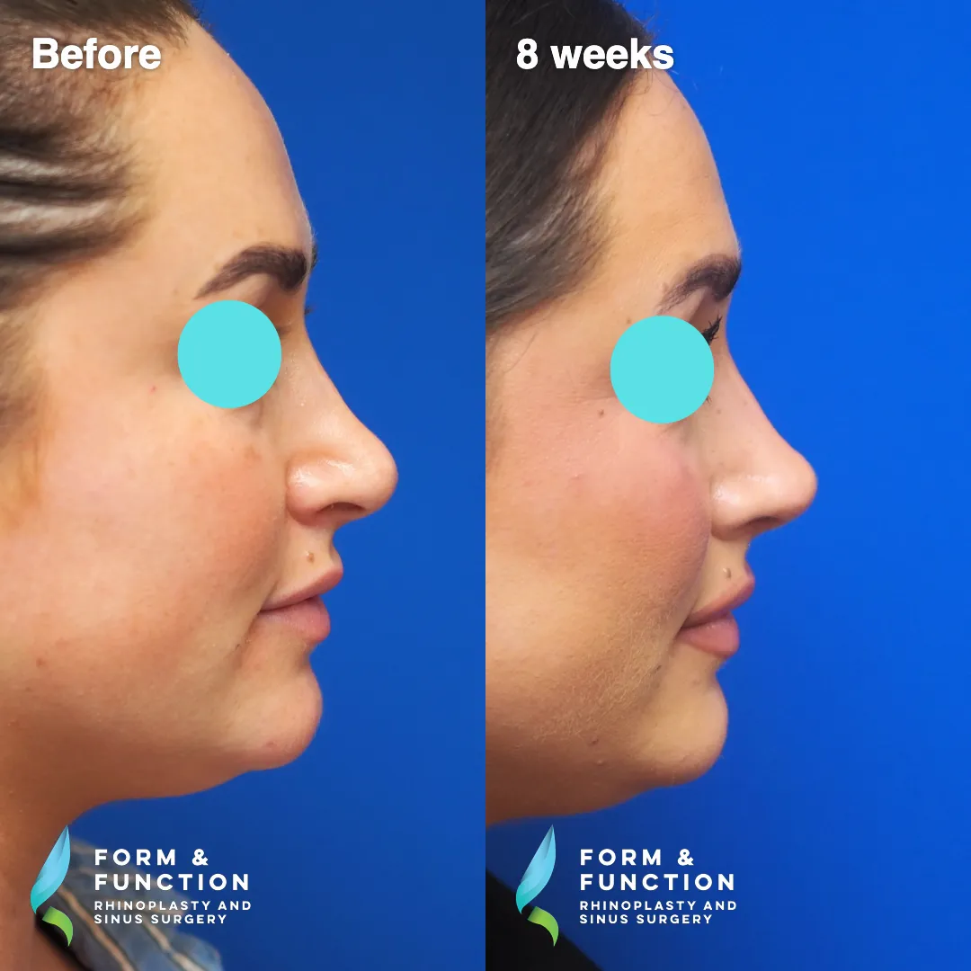 Before and after, left three-quarter view, 8 weeks after revision rhinoplasty with septal reconstruction