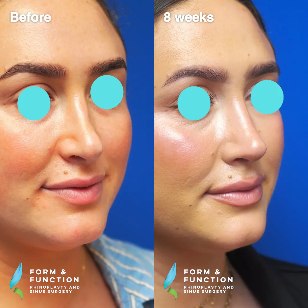 Before and after, base view, 8 weeks after revision rhinoplasty with septal reconstruction